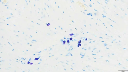 Mast cell staining with Toluidine Blue O showing purple-red mast cell cytoplasm and blue nuclei